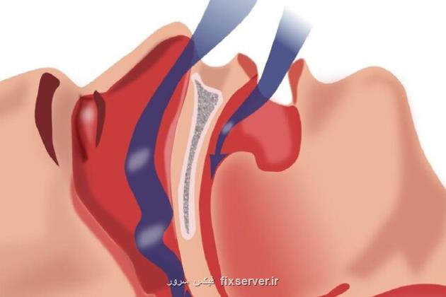 آپنه خواب خطر مبتلاشدن به پارکینسون را بیشتر می کند اما چاره دارد